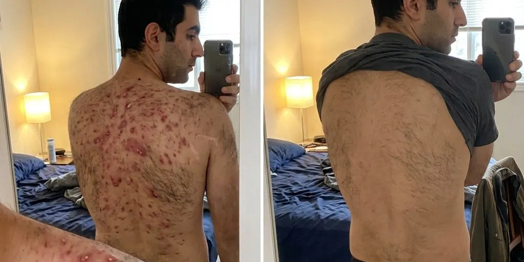 Samir's back weeks ago versus today after using Biosage patches